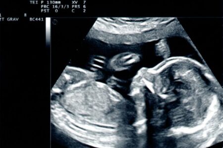 Torbiel podczas ciąży - co warto wiedzieć